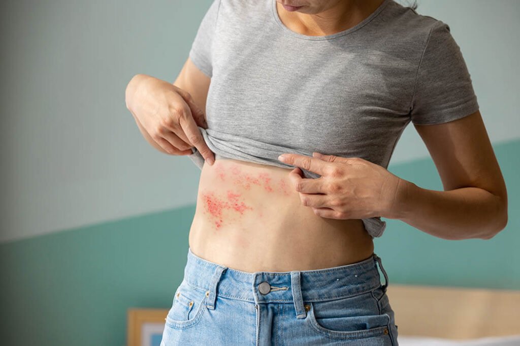 gürtelrose wie lange krank